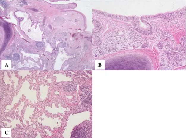 Figure 40.  Mature teratoma of the uterine cervix with pulmonary differentiation (H&E stain)