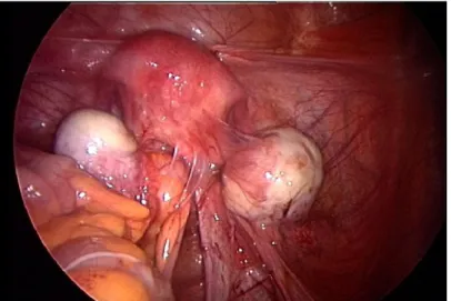 Figure 5. Ovarian endometriotic cysts 