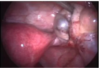 Figure 4. Superficial ovarian endometriosis 