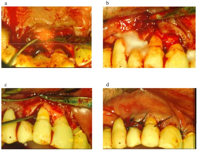 Figure 2: Clinical steps of EMD surgical technique (a: After removal of the granulation tissue the circumferential intrabony defects, b: Root conditioning with EDTA, c: EMD application by a syringue, d: Wound closure)