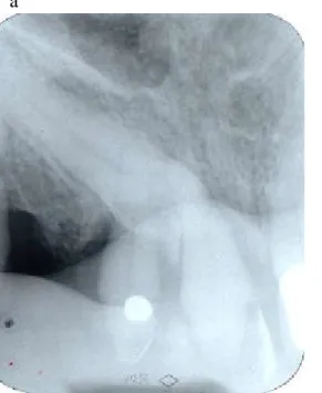 Figure 5: Radiographic view of the same defect (Note the difficulties when estimating the most apical extension of the defect, as the tooth -or root- behind the investigated tooth may mask the contour needed.