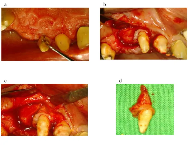 Figure 7: Surgical steps of tooth removal treated by EMD (a: Measuring the residual defect, b,c: Root removal with some of the surrounding tissues, d: Removed tooth for histological evaluation)