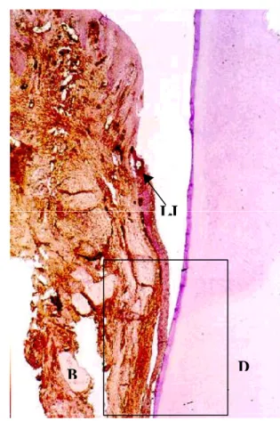 Figure 17: Photomicrograph of a human intrabony defect following treatment with conventional flap surgery