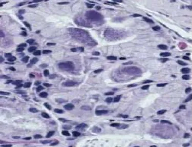 7. ábra  Intranuclearis (bagolyszem) zárványok CMV gastritis szövettani képén  A CMV fertőzés szövettani diagnosztikájának „gold standard”-ja volt a  haematoxylin-eosinnal (HE) festett biopsziás minták fénymikroszkópos vizsgálata során  cytomegaliás sejtek