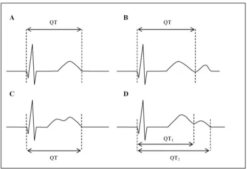 Figure 2.   (A) When the T wave morphology is normal, the T wave offset is identified          when the descending limb returns to the TP baseline; (B) when the T wave          is followed by a distinct U wave, the T wave offset is identified when the     