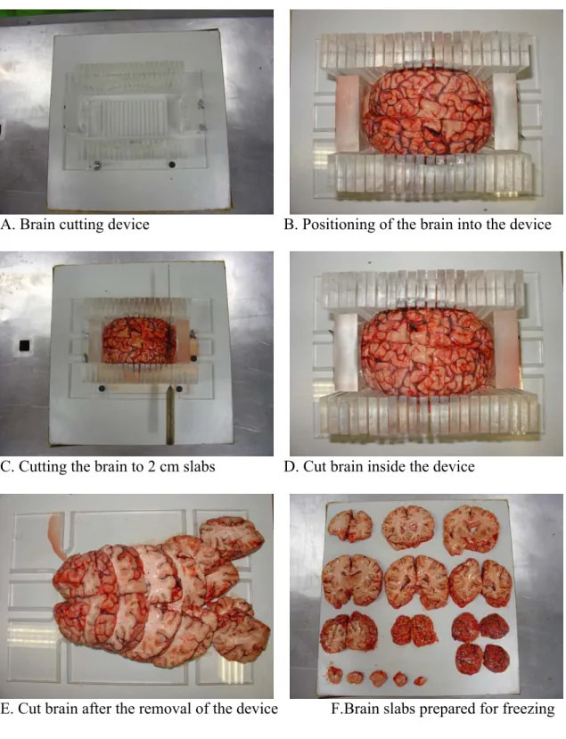 Figure 4. Preparation of the post-mortem human brain for freezing in dry-ice cooled isopenthane