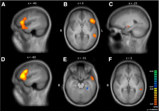Fig. 4. BOLD signal increase for metaphorical NNCs. A, B, C: (CM+NM)>(CL+NL); metaphors activated LIFG, left IFJ, left temporal pole, left posterior superior temporal sulcus.