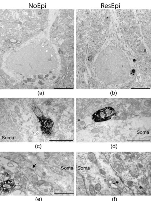 Figure 2. Electron microscopy of temporal neocortical slices stained with PV. Low magnification electron micrographs (a,b) show layer 2/3 pyramidal cells in the temporal neocortex of NoEpi (a) and ResEpi (b) patients in sections stained with the perisomati