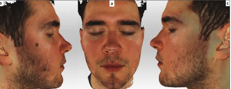 Figure 2:  Landmarks used in our study located directly on the 3D-facial images    (a) Frontal view