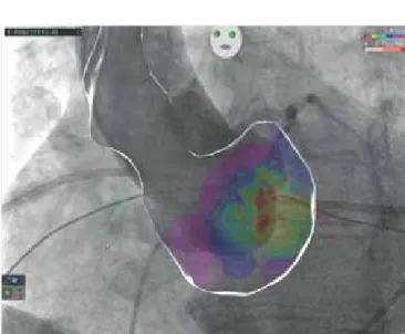 FIGURE 2. Image integration of 3D electroanatomic map  and aortic angiography during catheter ablation of PVC  arising from the aortic root