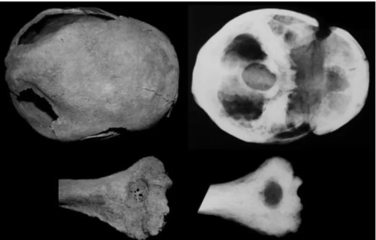 1. ábra: Biparietalis senilis osteoporosis a cranium-on és csontritkulás nyoma a jobb humerus-on,  Orosháza – Bónum , Faluhely (2013) – 75