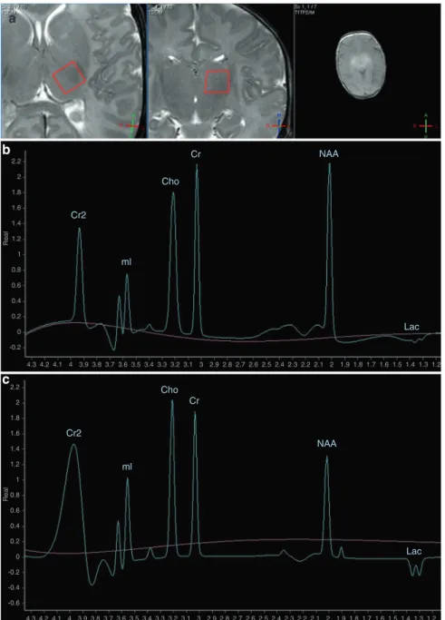 Fig. 2 Representative H-MRS spectra of newborns with moderate-to-severe HIE. a Gradient echo survey images acquired with echo time (TE) = 5 ms, repetition time (TR) = 75 ms, and 30° ﬂ ip angle for selection of volume of interest (VOI) from the left thalamu