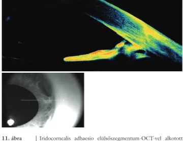 10. ábra A széles iridocornealis adhaesio miatt elhúzott pupilla, mely rá- rá-mutat a csarnokzugi abnormalitásra