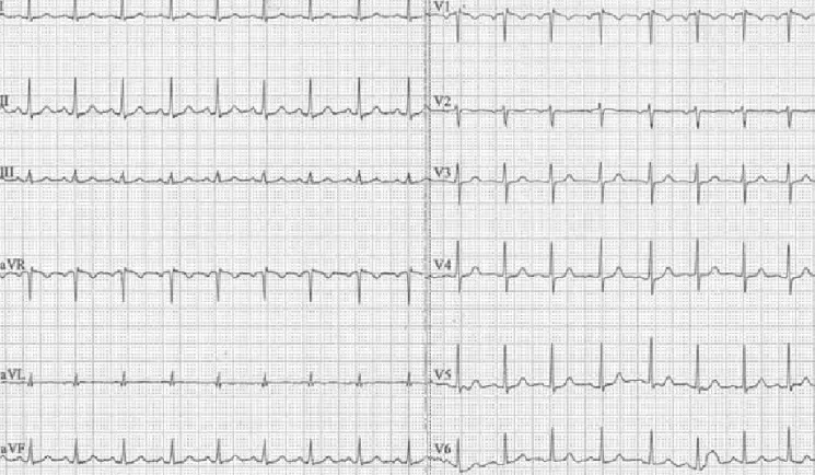1. ÁBRA. Szubaránytalan sinuscsomó-tachycardia 12 elvezetéses EKG képe. (Szívfrekvencia: 97/min; papírsebesség: 25 mm/s;  