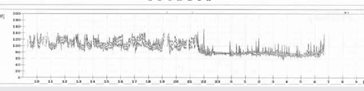 3. ÁBRA. Szubaránytalan sinuscsomó-tachycardiás beteg transztelefonos EKG-felvétele a palpitációs panasza alatt