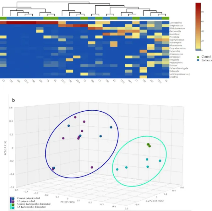 Figure 3.  Polymicrobial and lactobacillus dominated clusters of LS and control samples on heatmap (a)  and with Bray–Curtis principal coordinate analysis (PCoA) (b)