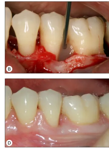 Kép 3:   Intraosszeális parodontális defektus kezelése EMD-vel   (EMD2 eset)  