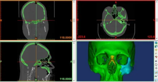 Fig. 2. (A) Skull surface and virtual eyeball and surrounding fat in 3-matic software, (B) marked sites in Ansys where loads was applied.