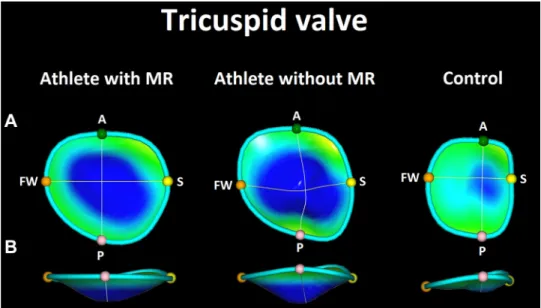 Figure 7. Three-dimensional (3-D) tricuspid annular reconstructions of athletes with and without mitral regurgitation (MR) and a healthy sedentary volunteer (control;  repre-sentative cases)