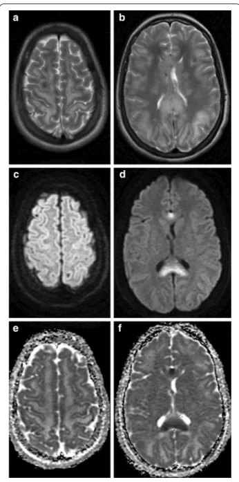 Fig. 2  A case showing microhemorrhages as seen on CT. Axial  native CT scan images at the level of the centrum semiovale and  the basal ganglia of a 16-year-old polytraumatised female patient  acquired on postoperative day 11 after hospital admission