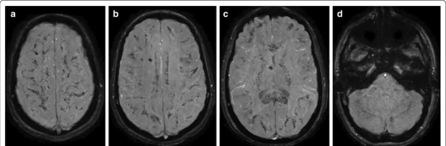 Fig. 5  A case representing the long-term radiological consequences  of CFE. T2 MRI images at the level of the basal ganglia of a 16-year-old  polytraumatised female patient acquired on day 12 after hospital  admission (a), and 16 months later (b)