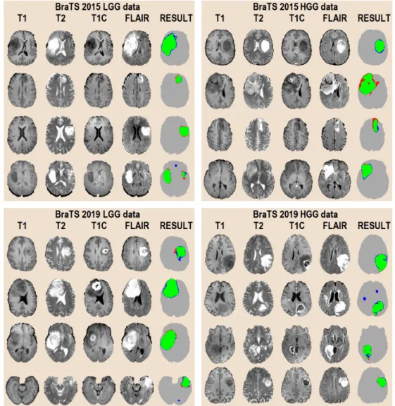Figure 7. One slice from 16 different MRI records, four from each data set, showing the four observed data channels and the segmentation result