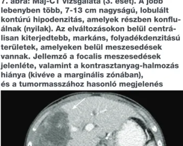 8. ábra: T2-súlyozott axiális MR-felvétel. 