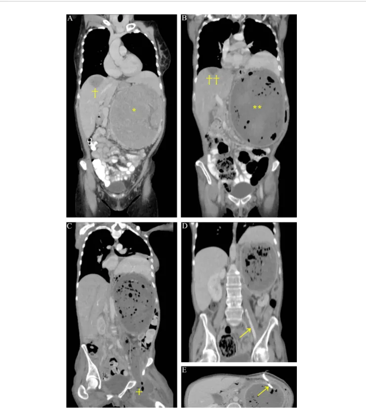 FIGURE 1 | CT scan of 20 cm large left adrenocortical carcinoma (*) with segment 8 liver metastasis (†)