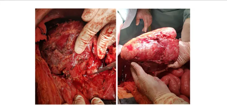 FIGURE 4 | Surgical removal of the necrotic primary tumor together with the left kidney after resolution of the descending abscess