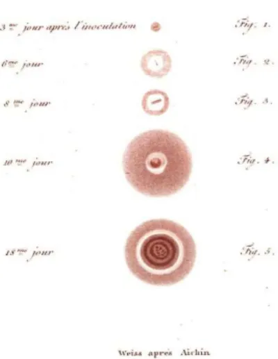 Figure 4: Evolution of the cowpox pustule on the 3rd, 6th, 8th, 10th and 18th days  following vaccination