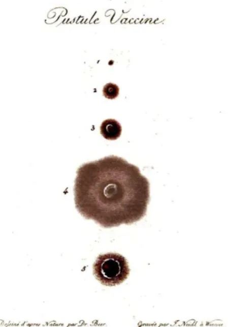 Figure 5: Evolution of the cowpox pustule. In Jean De Carro, Observations et  Expériences sur l’Inoculation de la Vaccine, 1801