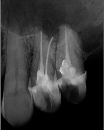 6. kép:  Kontroll intraorális röntgenfelvétel   a 24., 25. fogak endodontiai ellátását követően