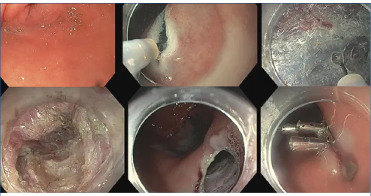 Figure 6.: Recommended surveillance in 25,945  patients with NDBE, NDBE, non-dysplastic  Barrett's esophagus