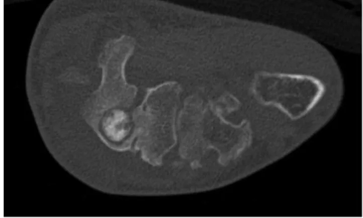 3. ábra Az I. eset, egy 22 éves férfi jobb csuklójának CT-vizsgálata, me- me-lyen az os hamatum állományában 9 mm-es, osteoid osteomára  típusos megjelenésű elváltozás látható
