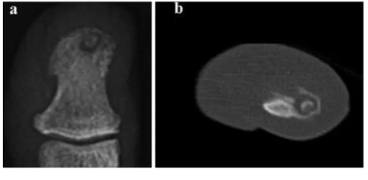 4. ábra A III. eset, egy 26 éves férfi jobb keze hüvelykujjának röntgen-  (a), illetve HRCT- (b) felvétele
