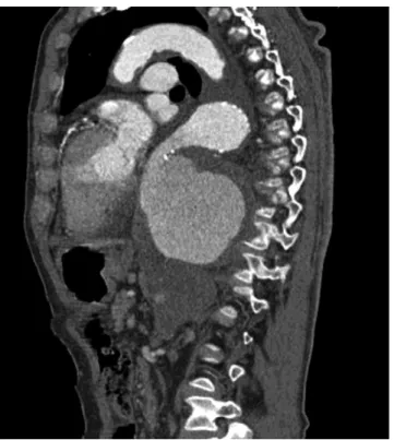 4. ábra Horizontális síkú CTA-felvétel; a képen látható az óriás méretű  aneurysma, illetve az általa okozott kardiális kompresszió, a bal  oldali haemothorax és az atelectasia is