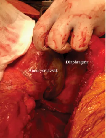 5. ábra Alulnézeti intraoperatív fotó a nagy méretű aneurysmáról a re- re-kesz magasságában