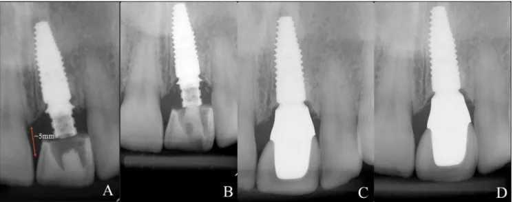 9. kép:  A: Az implantáció utáni kontroll röntgenfelvétel, B: 2 hónappal a műtét után,   C: 6 hónappal a végleges korona átadása után, D: 2,5 évvel a végleges korona átadása után