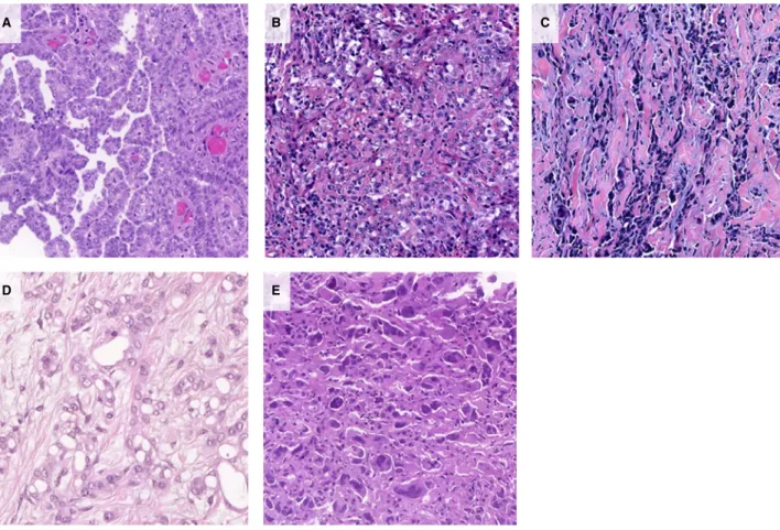 Figure 1. Histological subtypes of epithelioid malignant pleural mesothelioma (eMPM). A, Tubulopapillary pattern [haematoxylin and eosin (H&amp;E)]