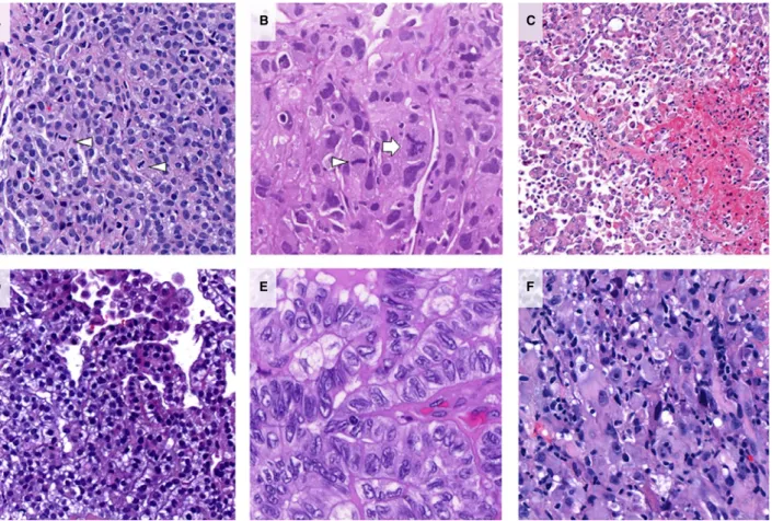 Figure 2. Mitosis, necrosis and nuclear grading in epithelioid malignant pleural mesothelioma (eMPM)