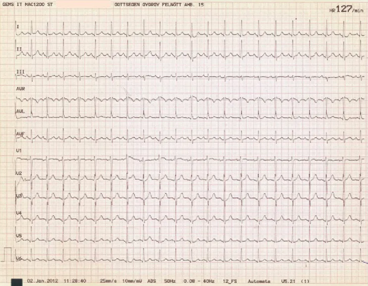 1. ÁBRA. Posztablációs aránytalan sinuscsomó-tachycardia jellegzetes 12 elvezetéses EKG-képe