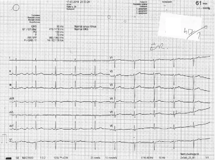 1. ÁBRA. A Fradi-szurkoló felvételi EKG-ja (62/min sinusritmus, normál EKG). A V 2 -V 3 -elvezetésekben az S-hullám kicsit széle- széle-sebb (50 msec), de a QRS 90 msec
