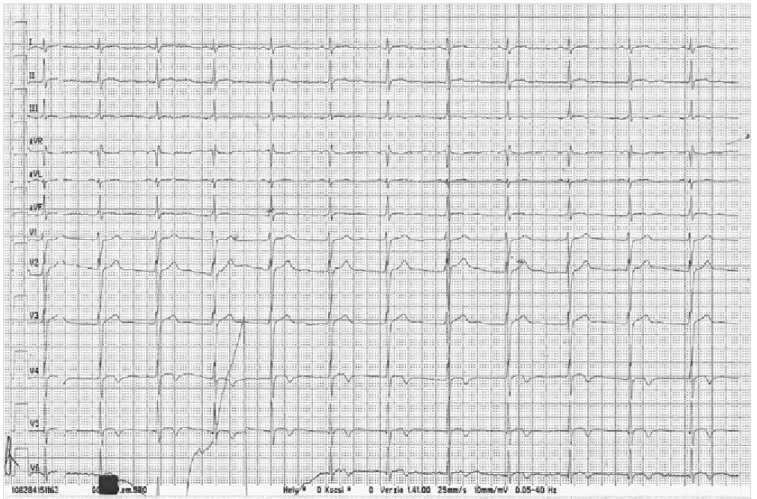 2. ÁBRA. A Fradi-szurkoló elbocsátási EKG-ja (67/min sinusritmus, V 4 -V 6  elvezetésekben negatív T-hullámok)