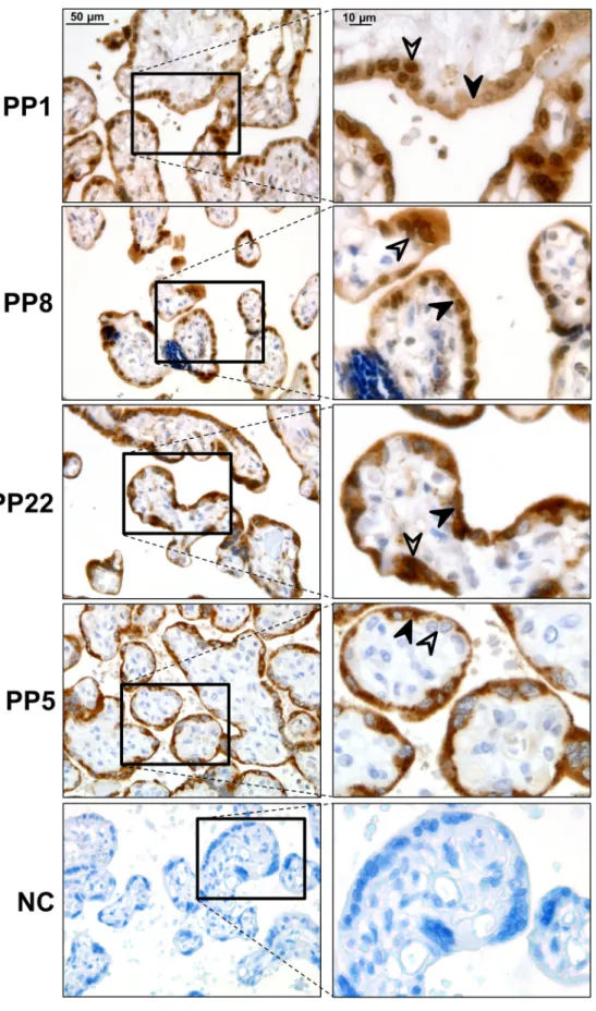 Fig. 2. Placental expression of placental  proteins  in  normal  pregnancies.  Strong  Placental  Protein  1  (PP1)  immunostaining  was  detected  in  cytotrophoblasts  and  the  syncytiotrophoblast