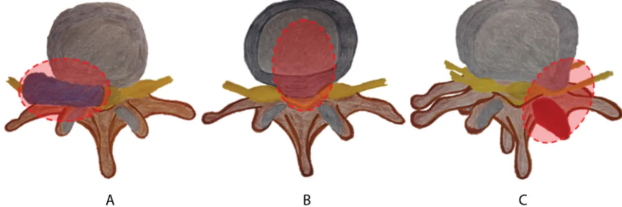 1. ábra A lumbalis-lumbosacralis fájdalom etiológiája. A) Súlyos szisztémás és ritka okok (5%, például csigolyametastasis, spinalis epiduralis abscessus, osteo- osteo-myelitis)