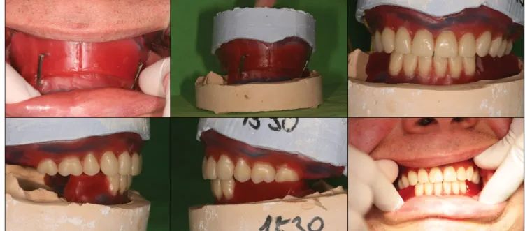 7. kép:  Centrális okklúzió meghatározása és diagnosztikus próbafogsor az artikulátorban és a szájban