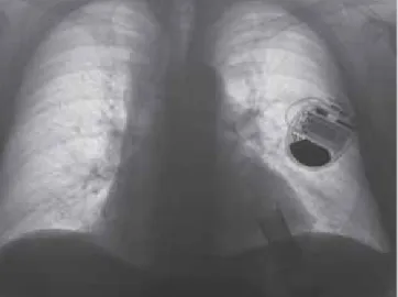 FIGURE 1. Patient’s chest X-ray showing the position of the  VVI-ICD system and left ventricular assist device in AP view