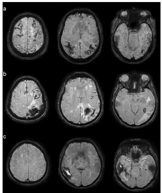 Fig. 3    Representative axial MRI-SWI images of probable CAA  patients at different parts of the spectrum