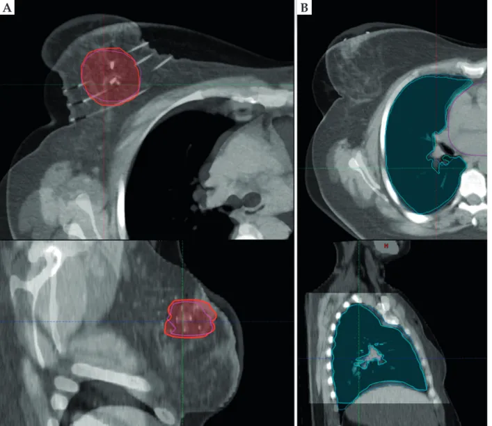 Fig. 1. Registration of the EBRT and BT CT sets based on CTVs (red and pink) (A) and the lung contours (turquoise and blue)  (B) on an axial (top) and a sagittal (bottom) plane 