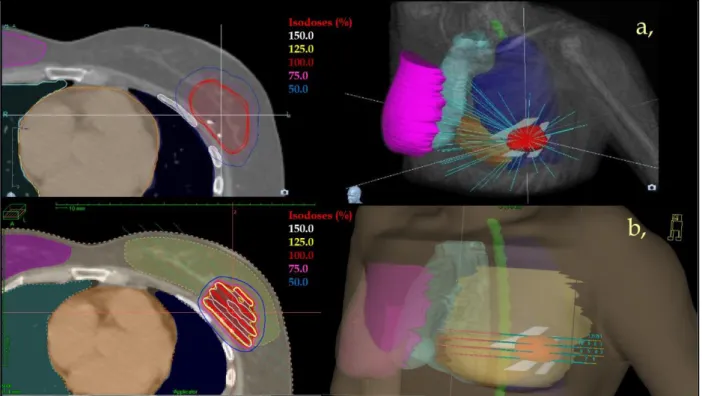 Figure 1. Axial CT slide (left) and 3D reconstruction (right) of a stereotactic CyberKnife 343 